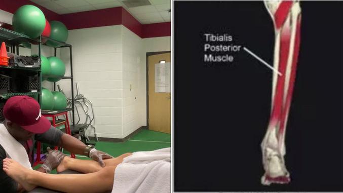 Posterior Tibial Tendon Dysfunction